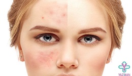 حساسیت پوستی چیست؟  انواع  و علائم حساسیت‌های پوستی